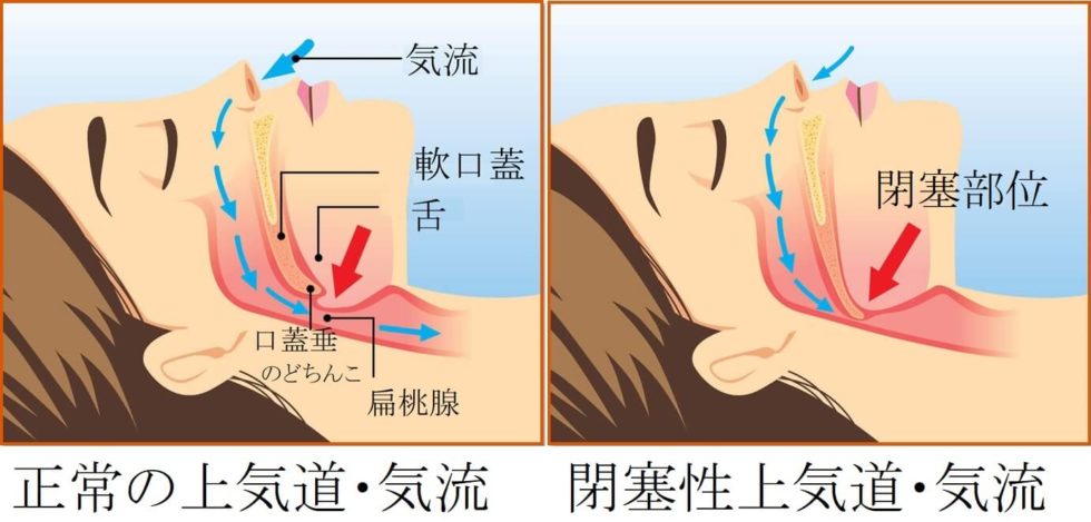 睡眠時無呼吸症候群と耳鳴りの間に関連性はありますか?