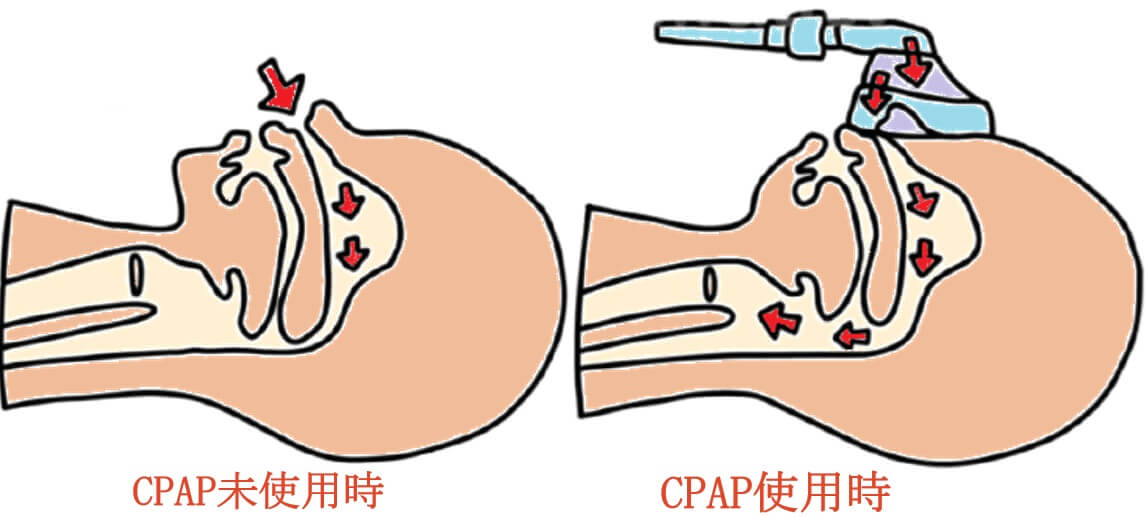 CPAP-mechanism CPAP therapy: how it works